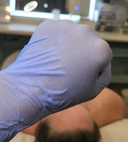 Acne Facial Extractions