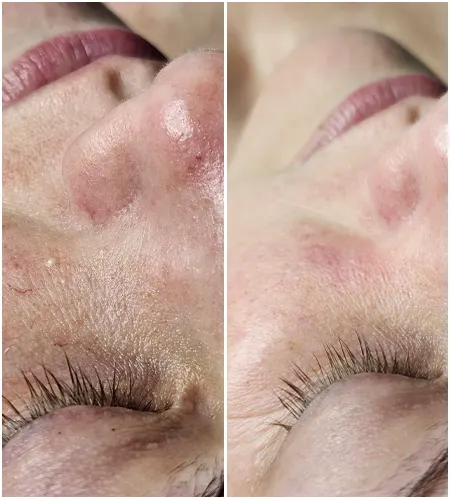 Bowmanville Facial Before After 03