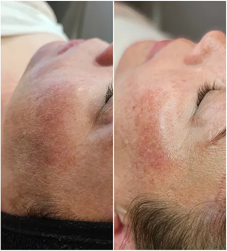 Bowmanville Facial Before After