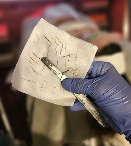 Dermaplaning is a non-invasive exfoliation